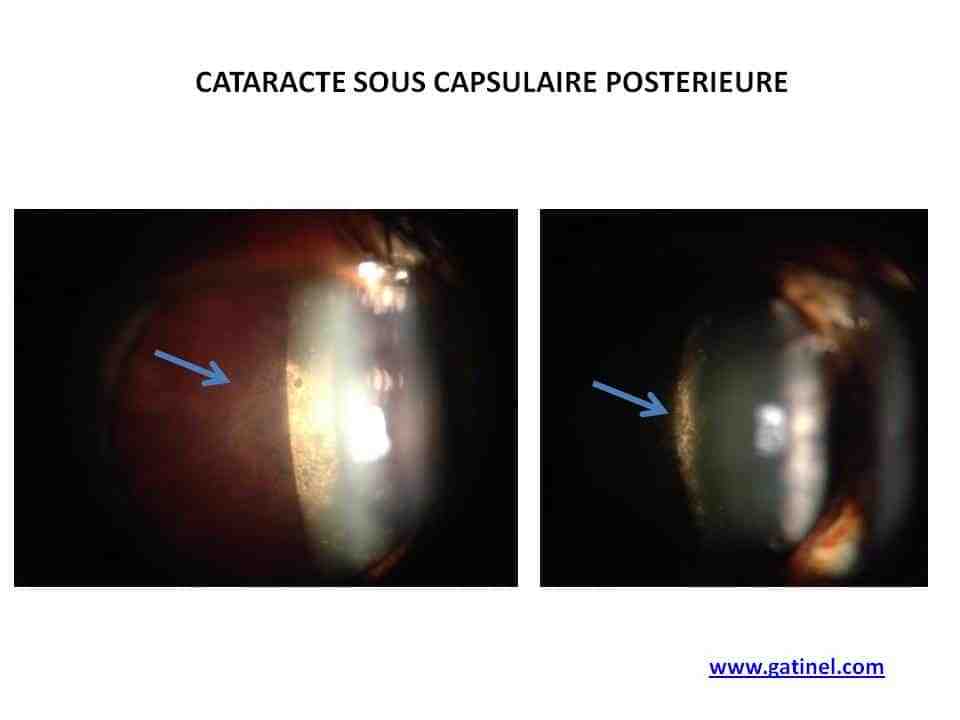 cataracte, sous, capsulaire, posterieure